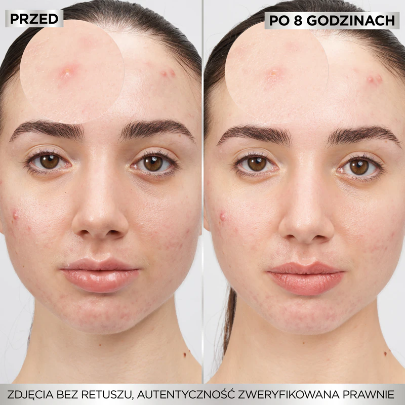 Adesivos Garnier Pure Active para acne, para pele com problemas de acne.