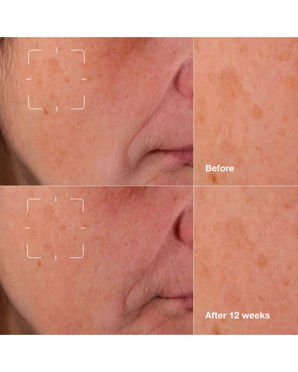 CLINIQUE Even Better Clinical™ Sérum na odstraňovanie tmavých škvŕn