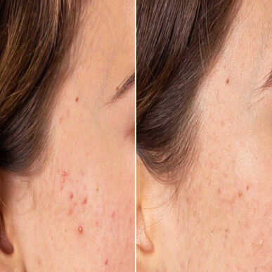 Freshly Cosmetics Azelaic Radiance Treatment Serum Tratamiento Piel Oleosa 100% Natural 50 ml 50 ml