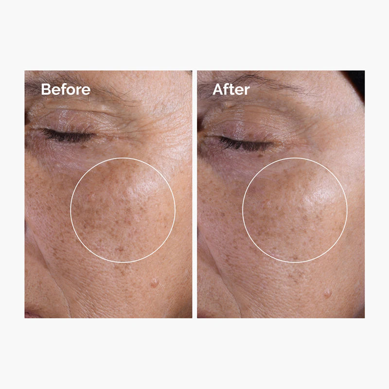 Tônico Esfoliante com Ácido Glicólico 7% da The Ordinary