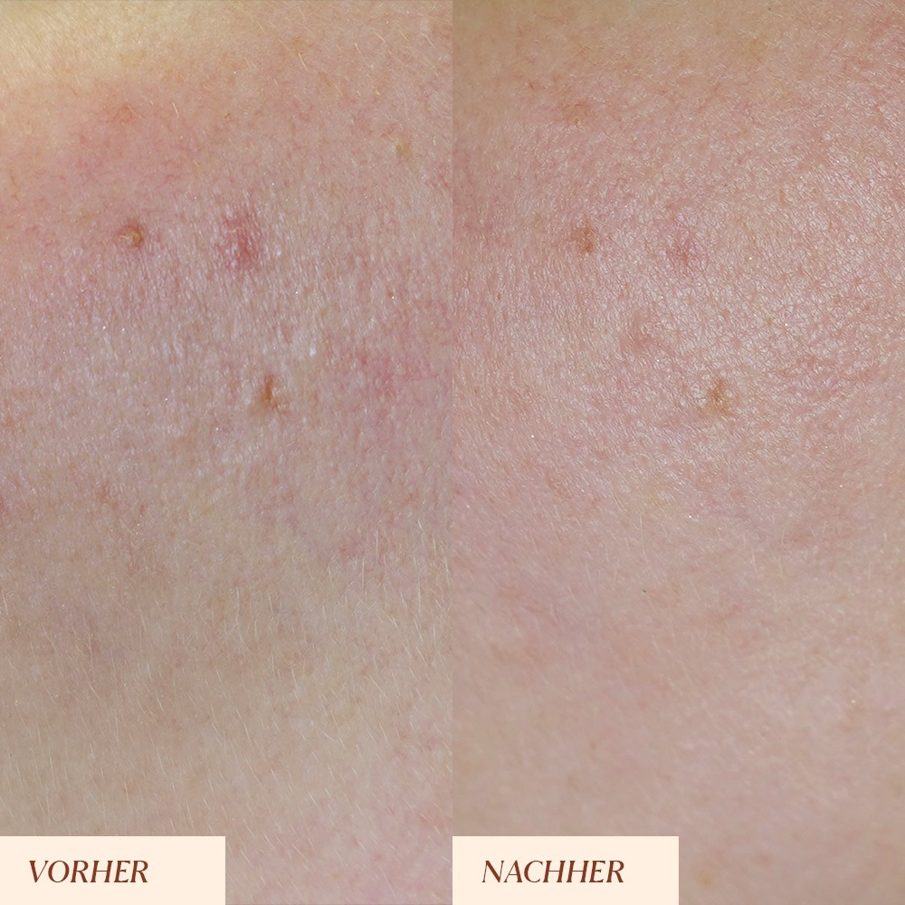 „Junglück“ kremas nuo pigmentinių dėmių ir odos nešvarumų – rutulinis – 5 ml
