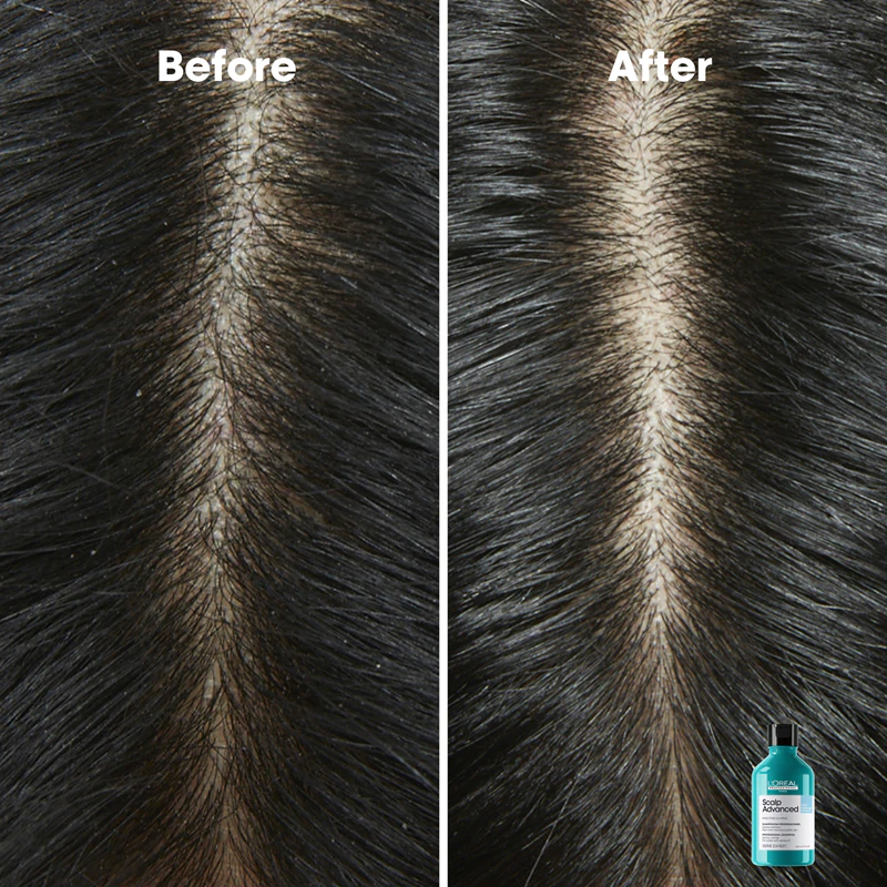 Šampón proti lupinám L'Oréal Professionnel Serie Expert Scalp Advanced