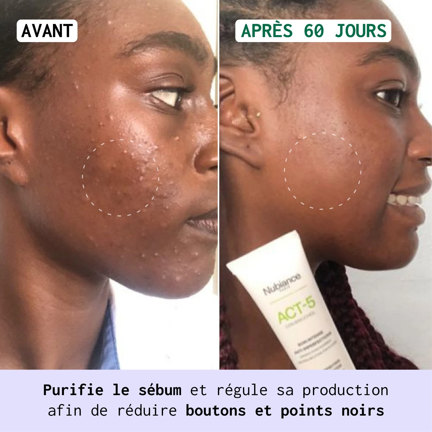 Nubiance ACT-5® - Soin intense Anti-imperfections