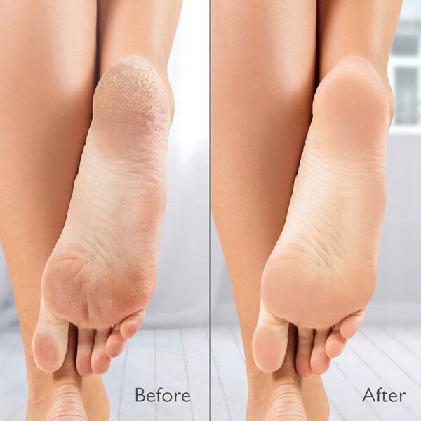 Silk'n VacuPedi