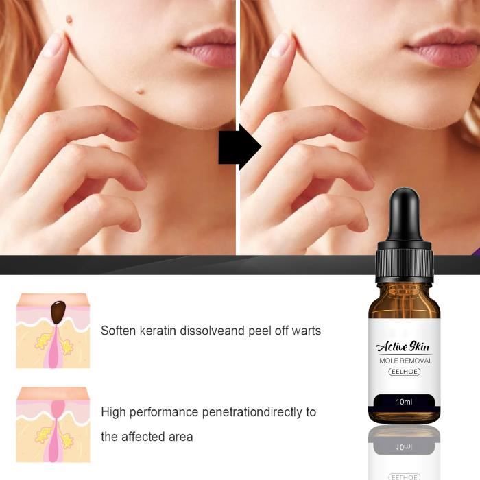 Esencia para disolver verrugas, para eliminar lunares, líquido para eliminar verrugas del cuello y la cara.