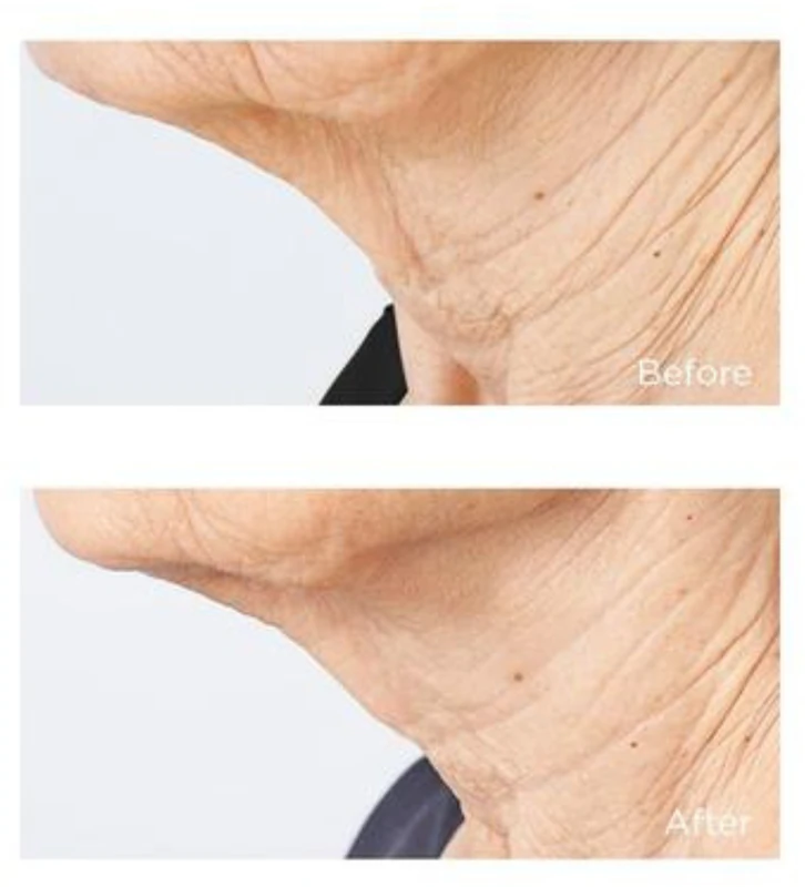 Perricone MD Cold Plasma Plus+ Sub-D/Creme Firmador para Pescoço e Decote
