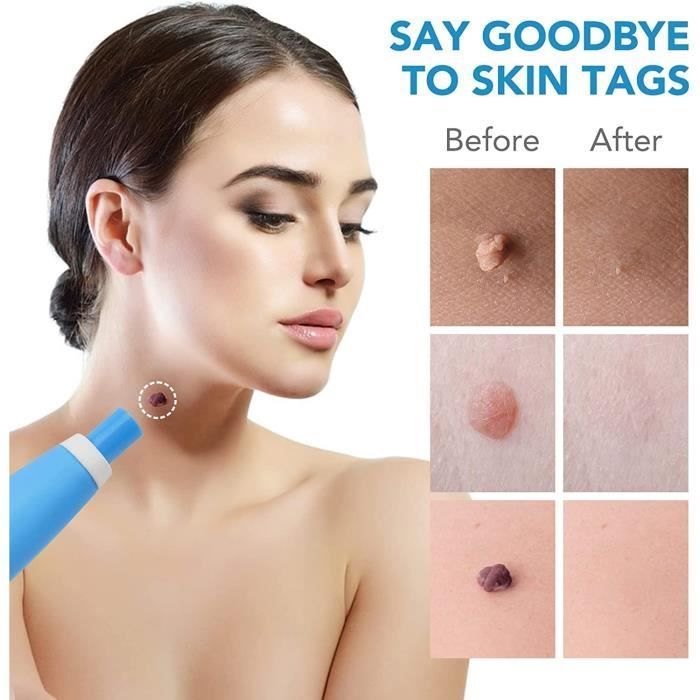 Tratamiento 2 en 1 para verrugas cutáneas, kit para eliminar verrugas cutáneas, lápiz removedor para rostro, cuello, dedos y cuerpo.