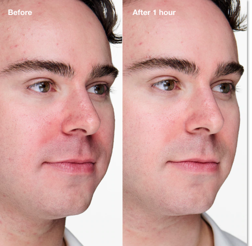 Anti-Blemish Solutions Clinical Advanced Anti-Imperfects Gel Luxusné cielené ošetrenia