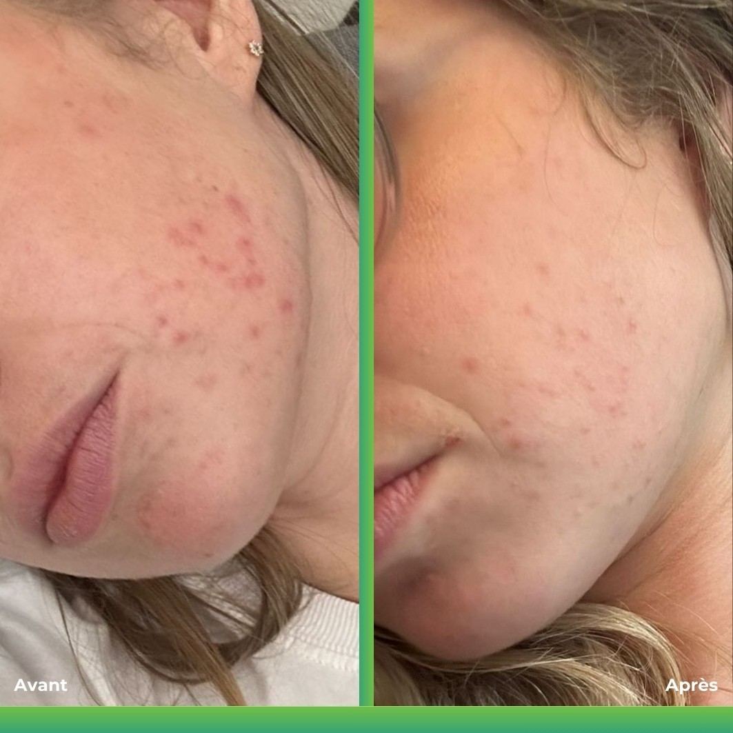 I.D. Swiss Botanicals Huile Régulatrice Imperfections Riche en Manuka et Tea Tree