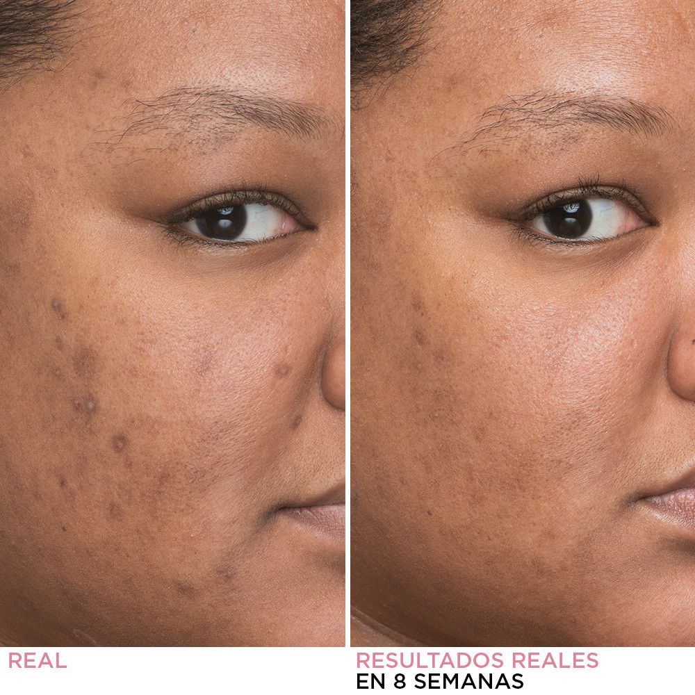 Sérum na tvár Bye Bye Dark Spots, minimalizátor tmavých škvŕn Luxusné sérum proti tmavým škvrnám