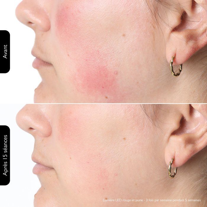 Masque Led Luminotherapie Silk'n Lumino - 100leds - Anti-âge / Anti-imperfections