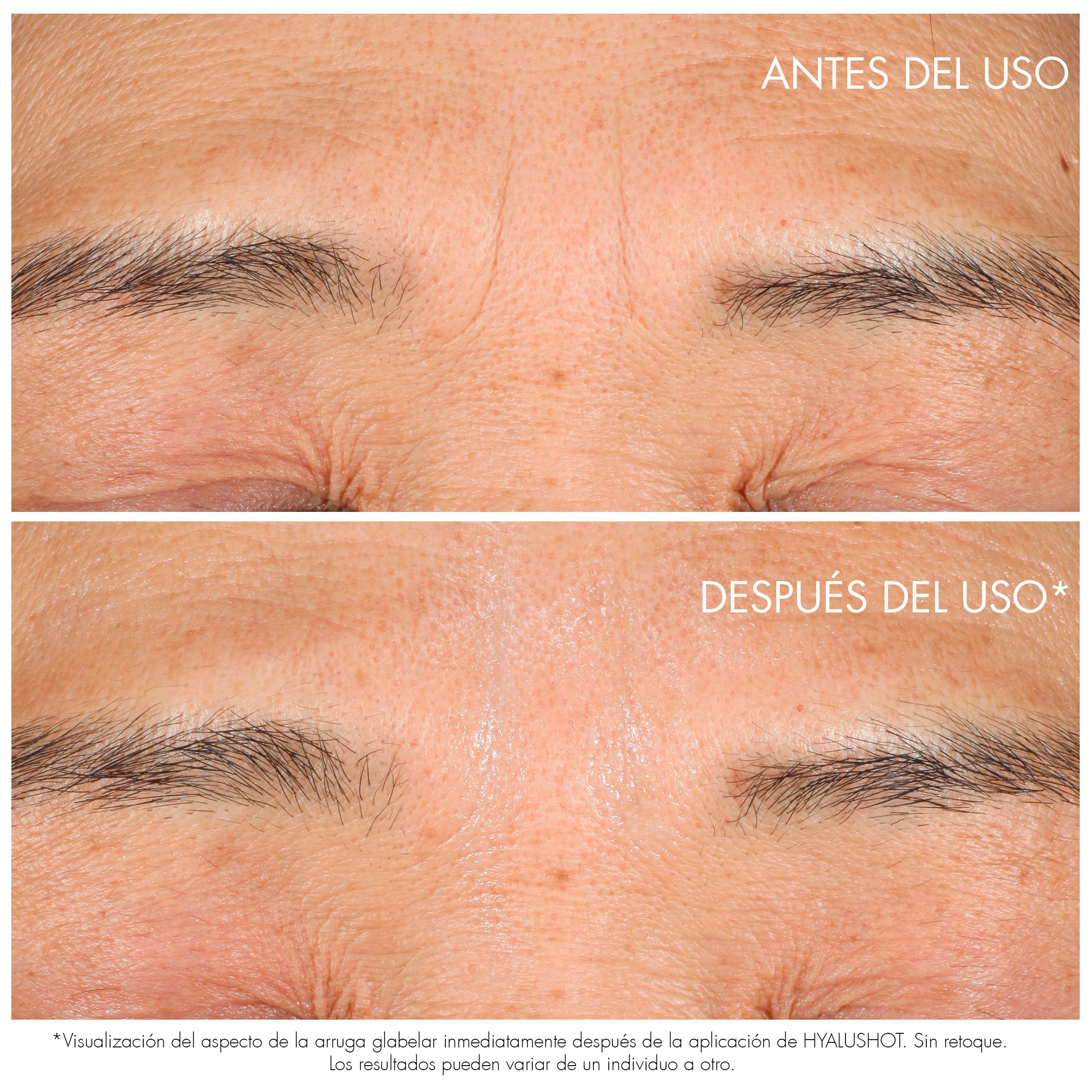 Capture Totale Hyalushot Wrinkle Corrector Luxusný prípravok proti vráskam a starnutiu