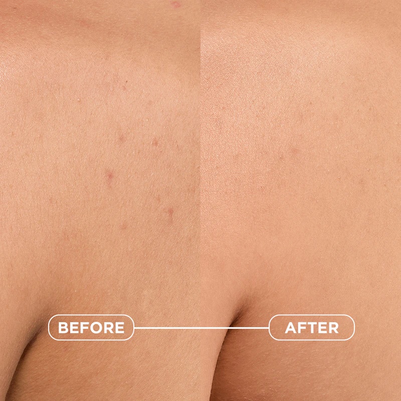 „Bioderma Sébium Kerato+“ kūno purškiklis nuo spuogų, paraudimo ir spuogų randų