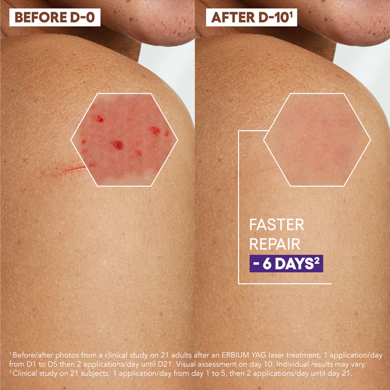 A-Derma Epitheliale AH Ultra Repair Herstellende Crème Anti-vlekken crème voor de geïrriteerde huid