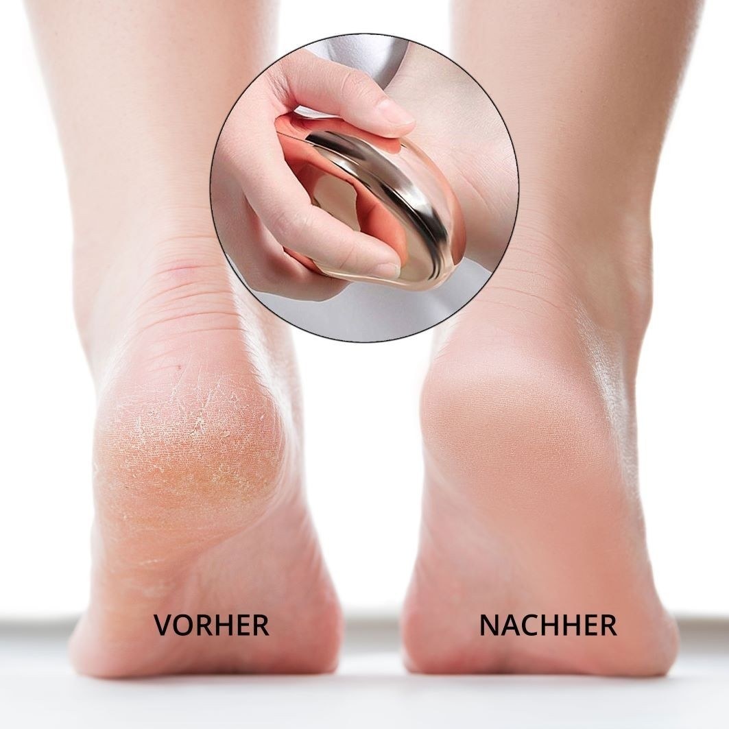 Ailoria Hornhautentferner Doucette PRO Fußhornhautentferner - 1 Stück