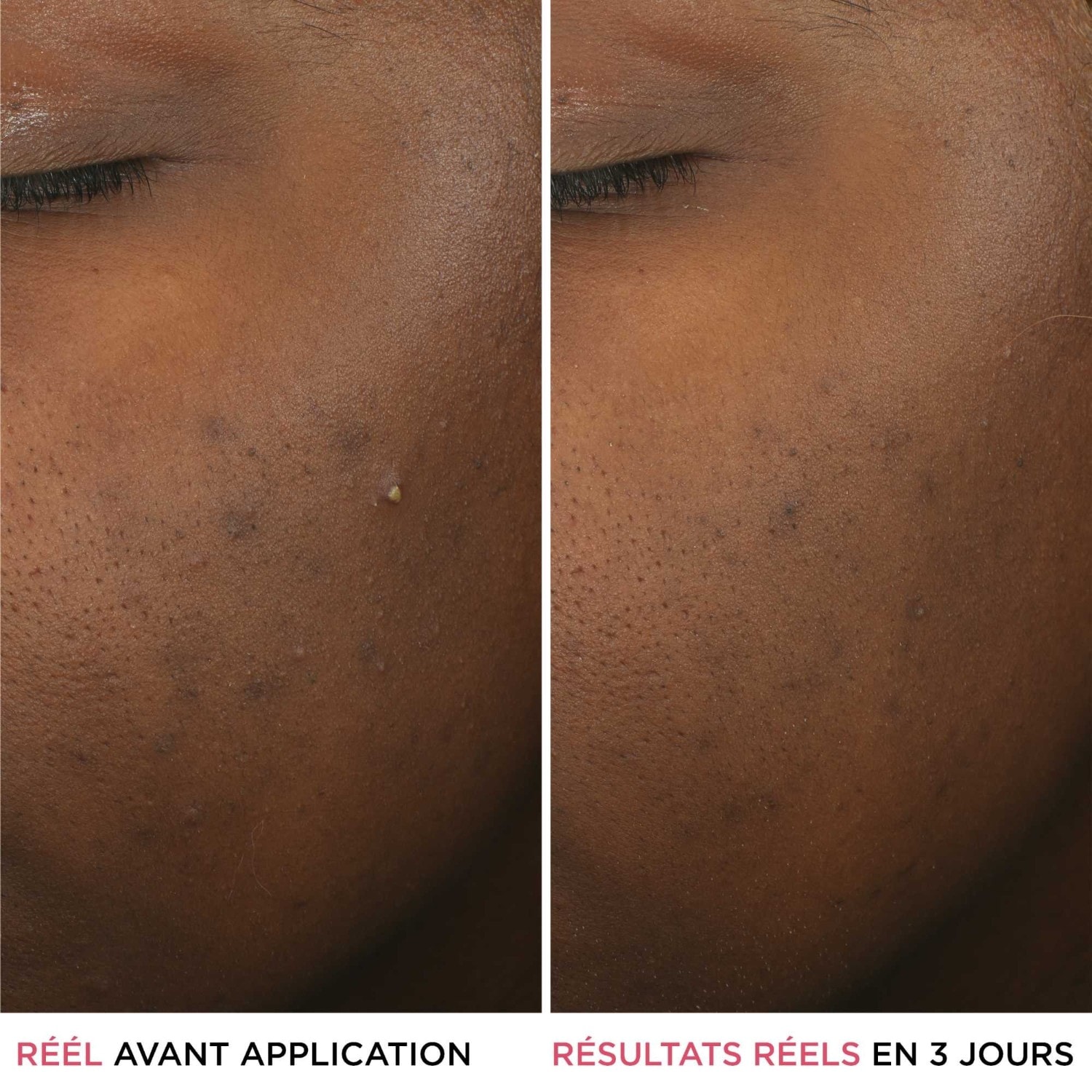 IT Cosmetics Sérum anti-éruptions cutanées à l'acide salicylique