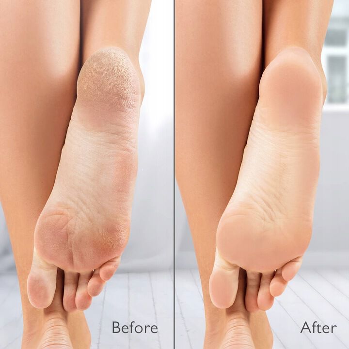 Silk'n VacuPedi
