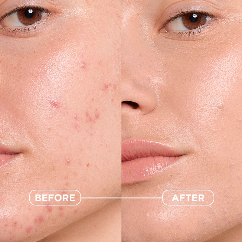 Bioderma Sébium Kerato+ Cover матирајућа тонирајућа крема против несавршености коже склоне акнама