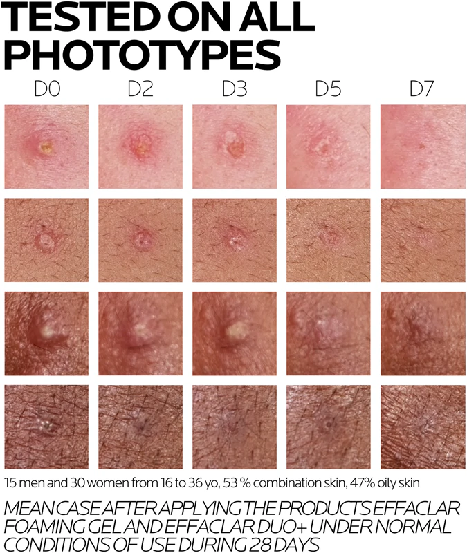 La Roche-Posay Effaclar DUO (+M) cuidado corretivo e restaurador para pele com imperfeições e acne