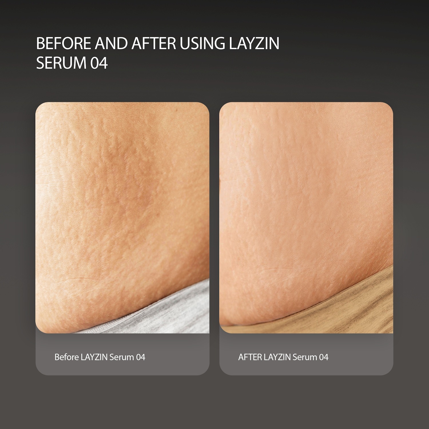 LAYZIN Sérum proti pupienkom 04 – Pleťové sérum na regeneráciu a redukciu jaziev – 30 ml