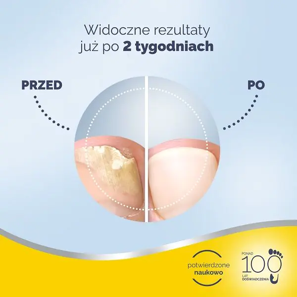 Scholl Fungal Nail Treatment, Preparat przeciwgrzybiczy do paznokci