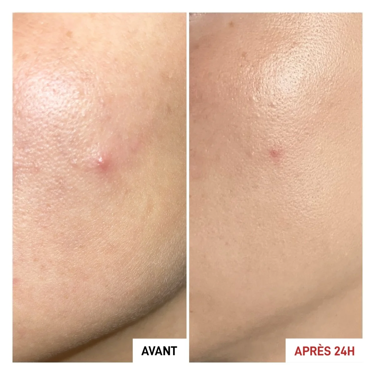 Centella Asiatica Centella SOS Patch - Siero viso antimperfezioni, Tratt.viso 24 ore antimperfezioni