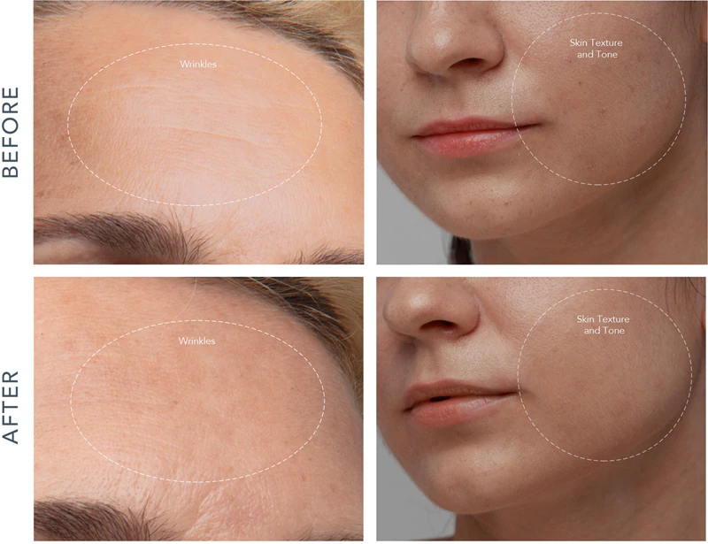 Prístroj FOREO KIWI™ Derma na diamantovú mikrodermabráziu a hĺbkové čistenie tváre