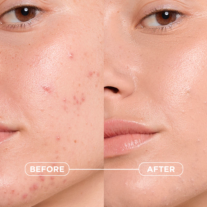 Bioderma Sébium Kerato+ Cover zmatňujúci tonizujúci krém proti nedokonalostiam pleti náchylnej na akné