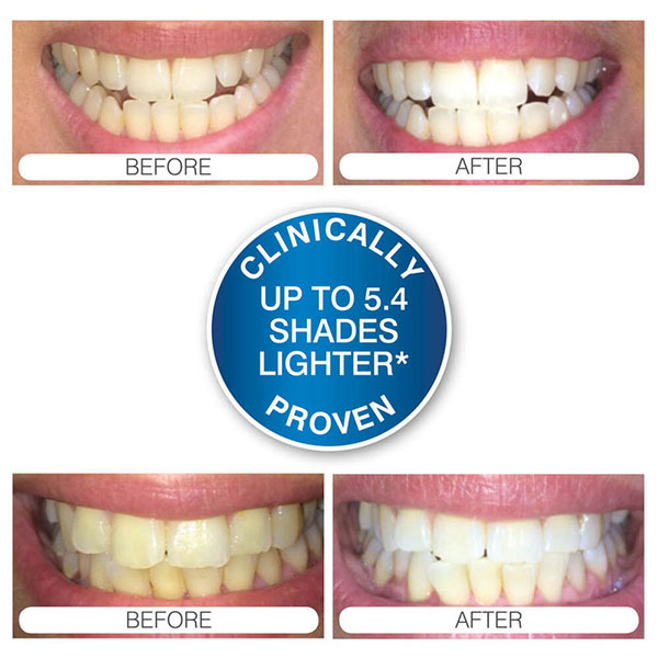Blanqueamiento dental avanzado con luz azul Rio Smile White