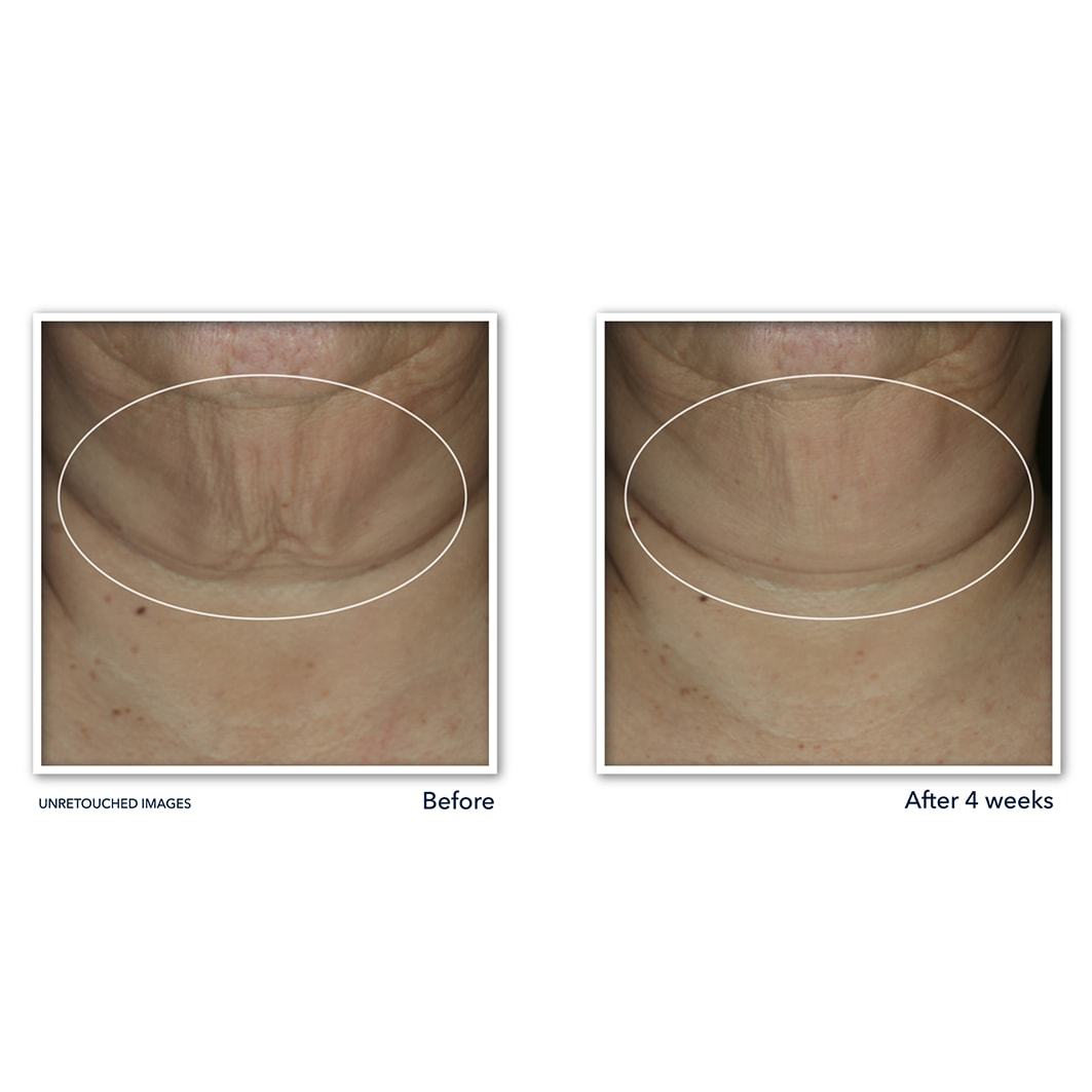 RoC серум против старења, серум за истезање коже Derm Correxion, стик - 30 г