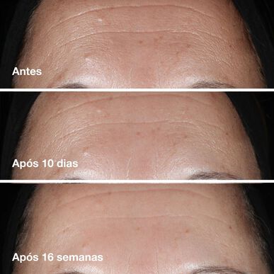Clinique Smart Clinical Repair Wrinkle Correcting Serum - Ikääntymistä ehkäisevä, kiinteyttävä ja hehkuttava seerumi