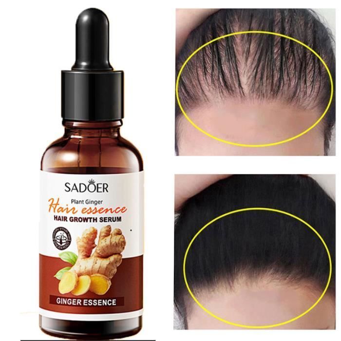 Sérum para el crecimiento rápido del cabello, aceite esencial de Lauren, anticaída, previene la sequedad y el adelgazamiento del cabello.