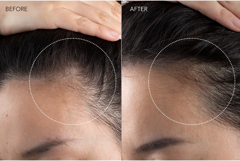 FOREO FAQ™ 301 Haargroeistimulator