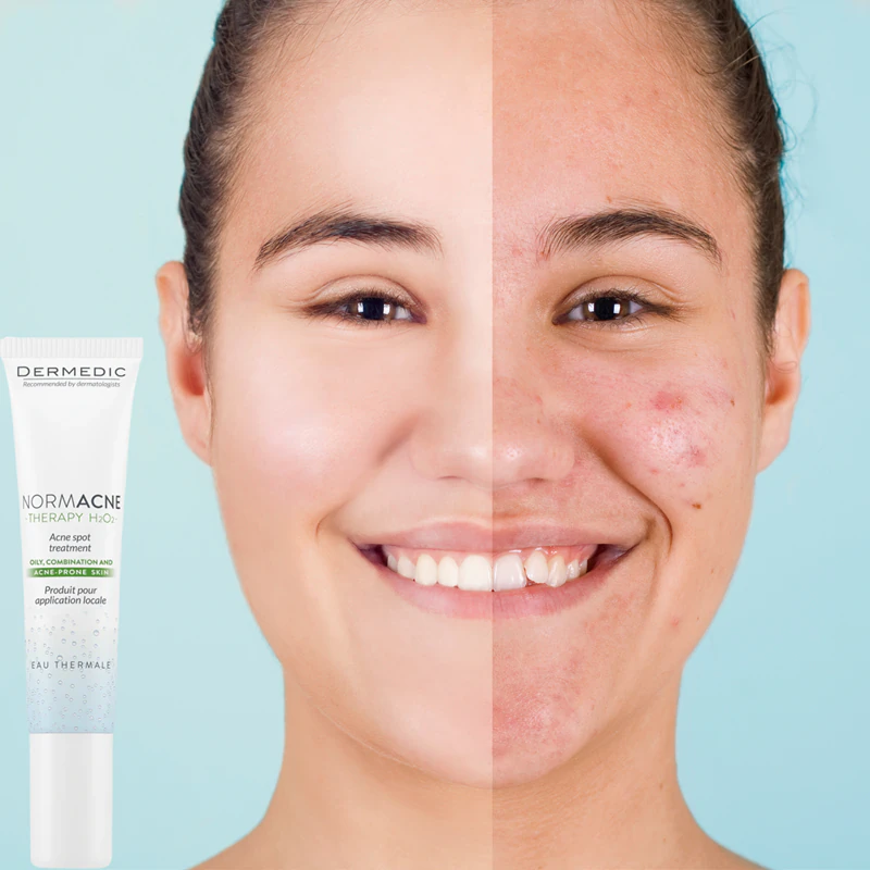 Dermedic Normacne Therapy: plaatselijke behandeling van acne-lesies.