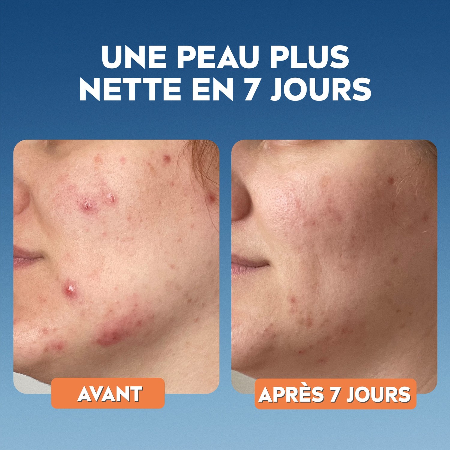 NIVEA Soin de Nuit exfoliant visage à l'acide Salicylique peaux à imperfections tendance acnéique