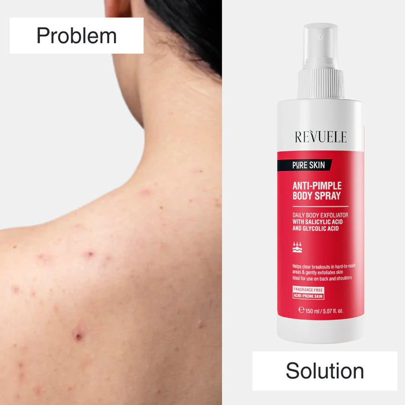 Revuele Pure Skin tělový sprej proti pupínkům a akné