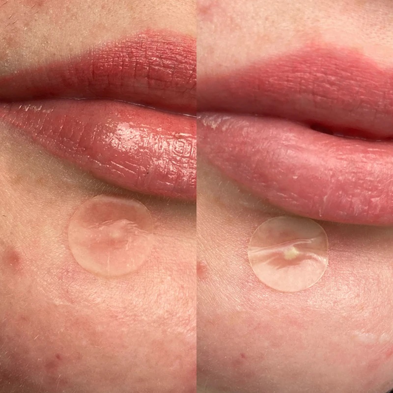 „Hero Cosmetics Mighty Patch“ nematomas medicininis pleistras nuo spuogų
