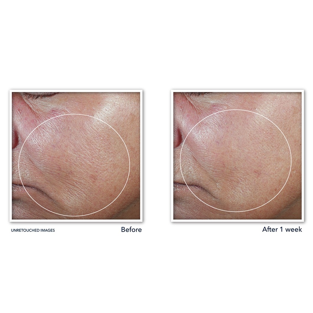 RoC serum proti staranju Derm Correxion serum v stiku za raztezanje kože - 30 g