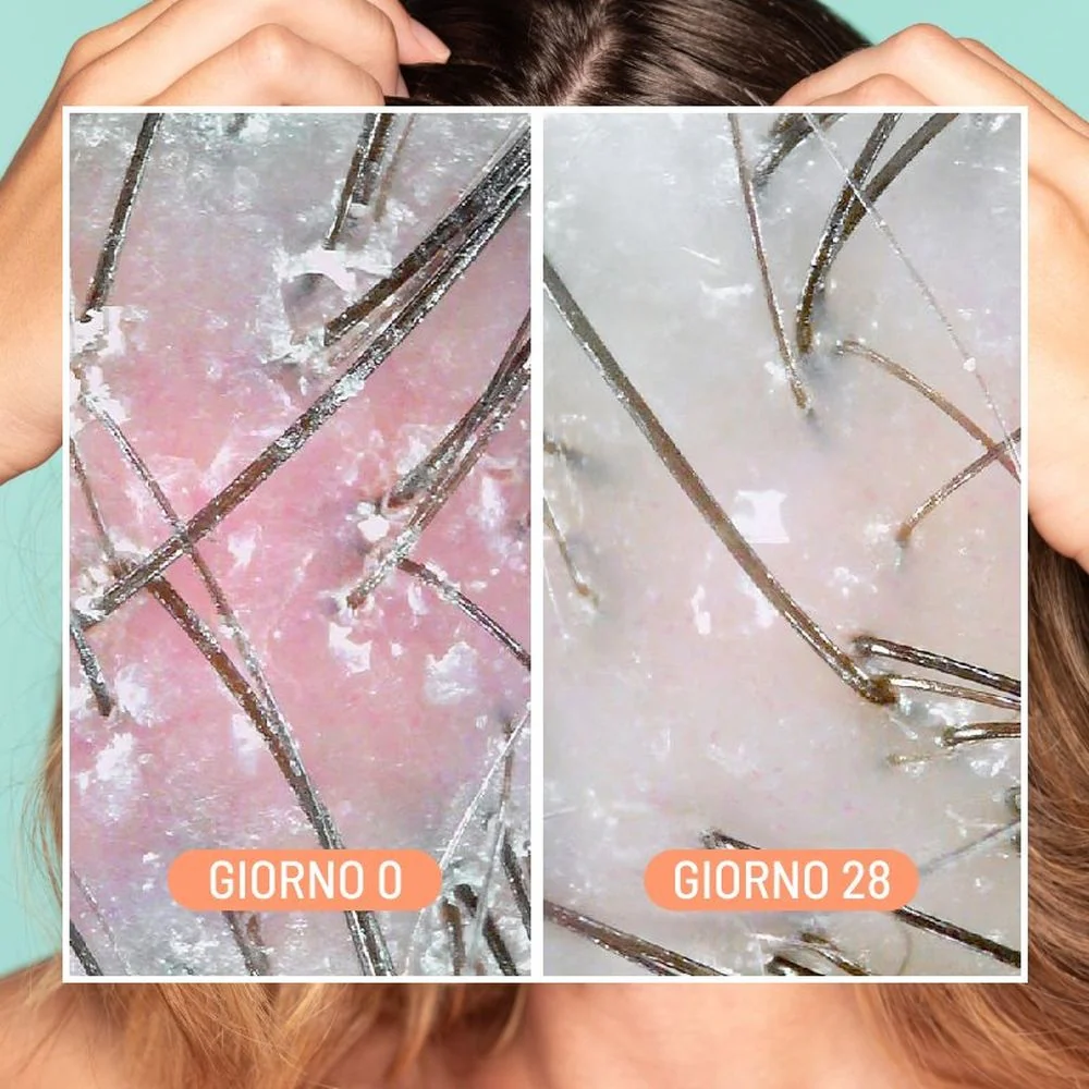 Cura dei Capelli Dandruff & Scalp Exfoliating Treatment - Scrub Capelli, Trattamento Cuoio Capelluto, Trattamento Antiforfora