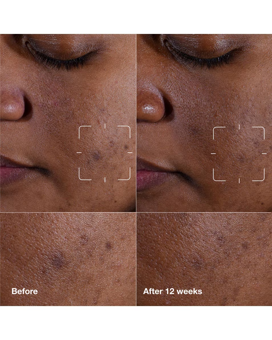 CLINIQUE Even Better Clinical™ Ορός Καθαρισμού για τις Σκούρες Κηλίδες
