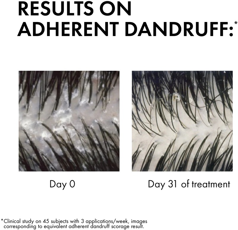 Vichy Dercos Anti-Dandruff šampūnas normaliems ir riebiems plaukams