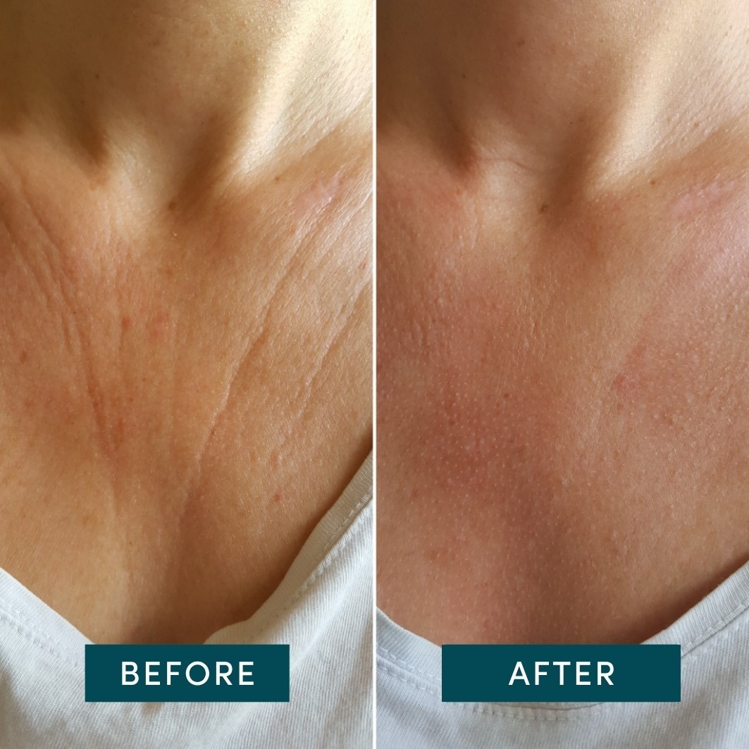 Apricot Neck & Décolleté Décolleté Pad Hyaluron – 30 gab