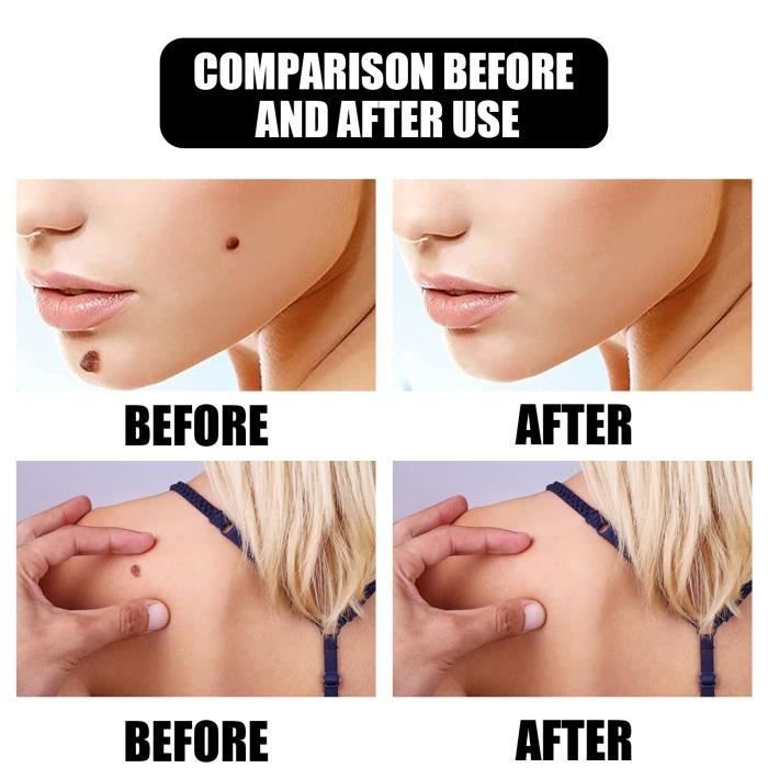Esencia para disolver verrugas, para eliminar lunares, líquido para eliminar verrugas del cuello y la cara.