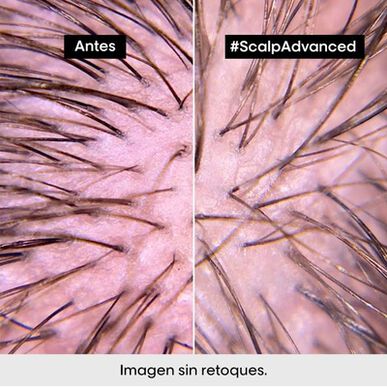 L'Oréal Professionnel Serie Expert Scalp Advanced Inconfort Treatment après-shampooing apaisant pour cuir chevelu sensible 200 ml