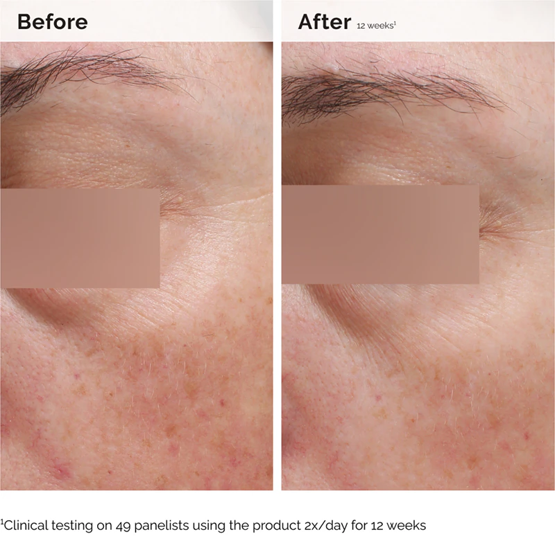 emulsão facial e corporal The Ordinary Niacinamide 5% é uma emulsão hidratante leve e antiacne.