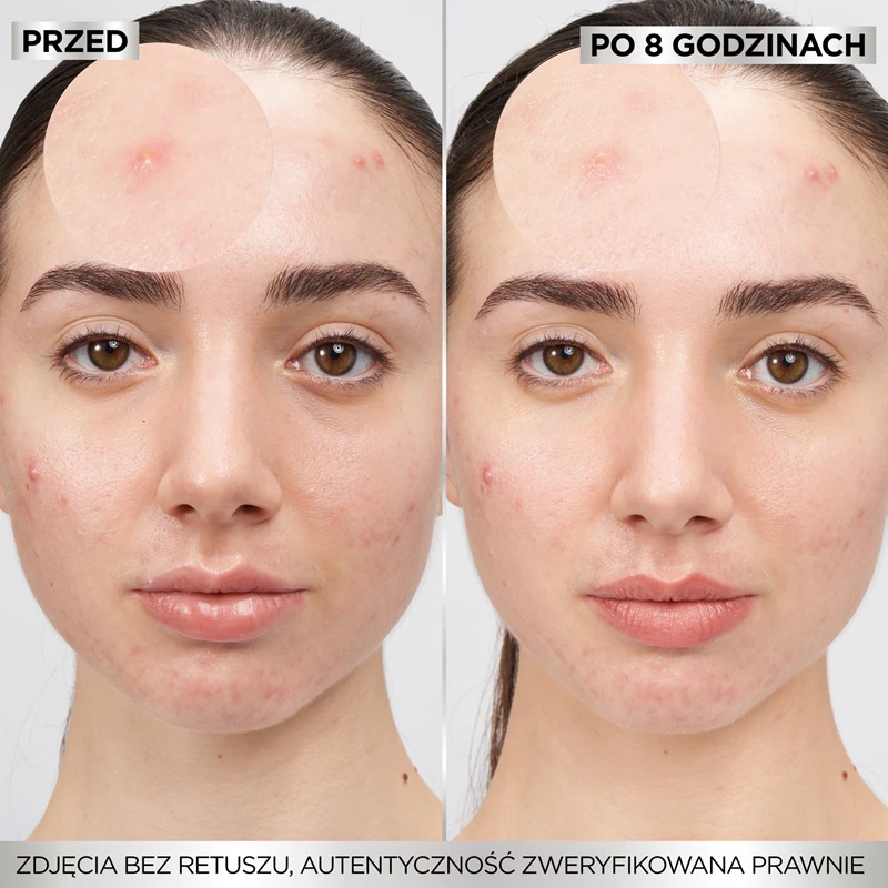 Garnier Pure Active Pimple Patch obliži za problematično kožo proti aknam
