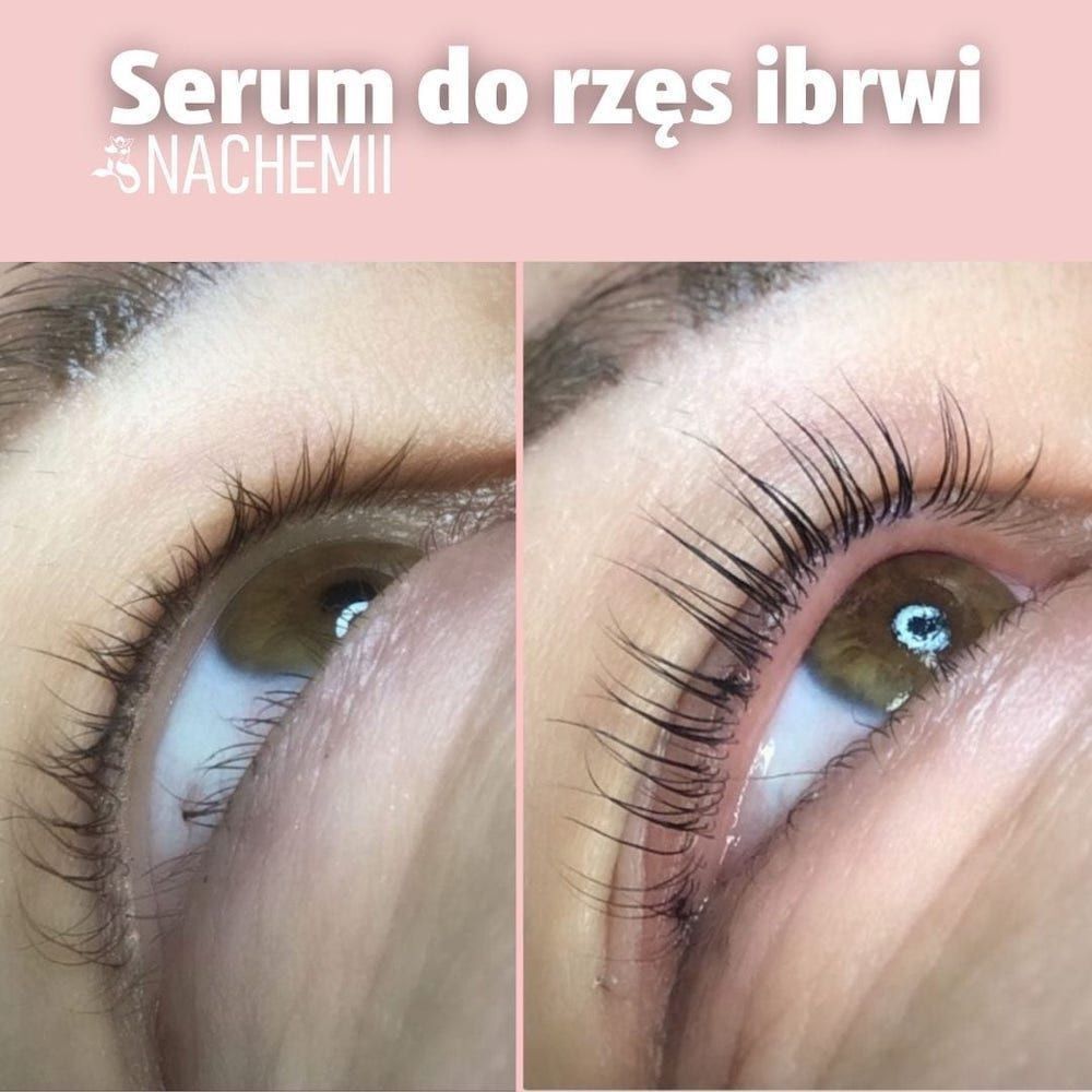Nachemii serum za trepalnice