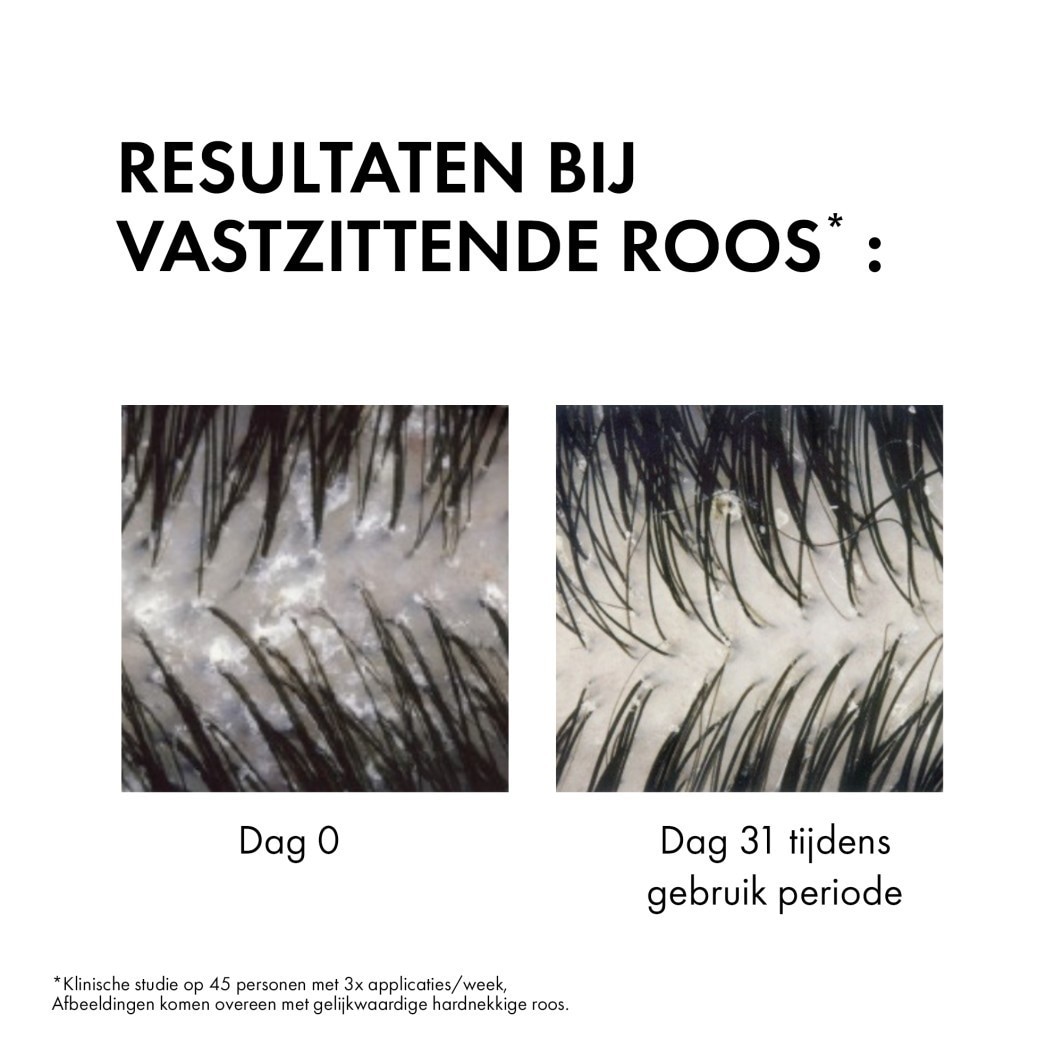 Vichy Dercos Anti-Dandruff Shampoo, Dermatologinen shampoo normaaleille ja rasvoittuville hiuksille - Hilsettä ehkäisevä
