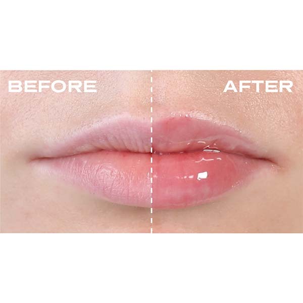 Umplere buze cu acid hialuronic 3ml