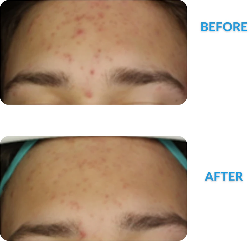 Creme Dermedic Redness Calm para vermelhidão e capilares dilatados.